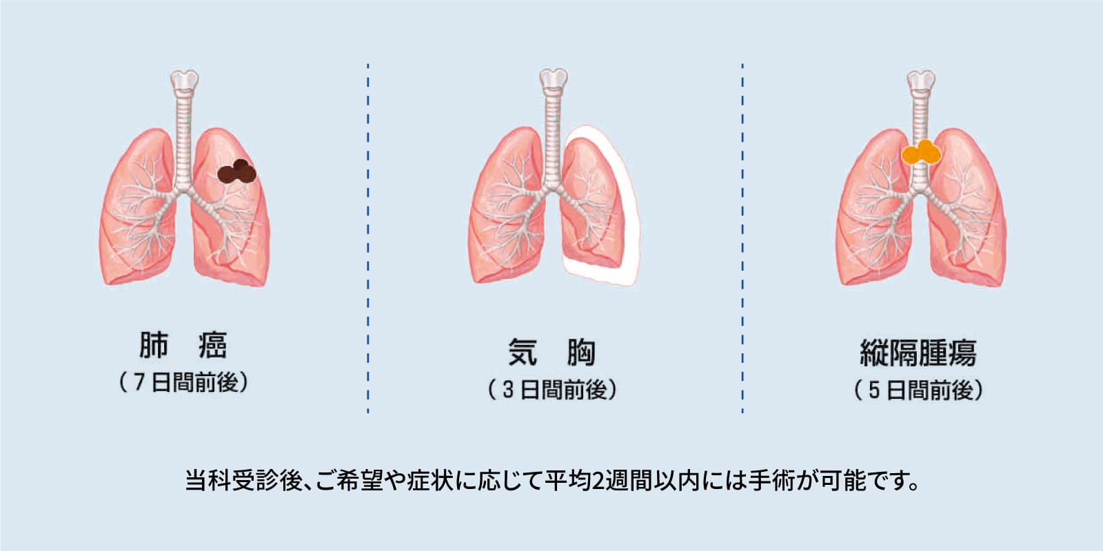 最新のデザイン 呼吸器外科手術縦隔・胸膜・胸壁 イラストと動画で学ぶ